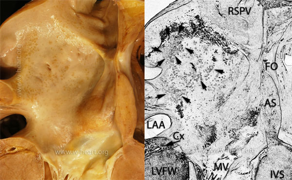 Amyloid Gross Image